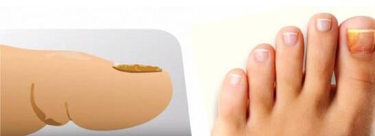 fungus on nails