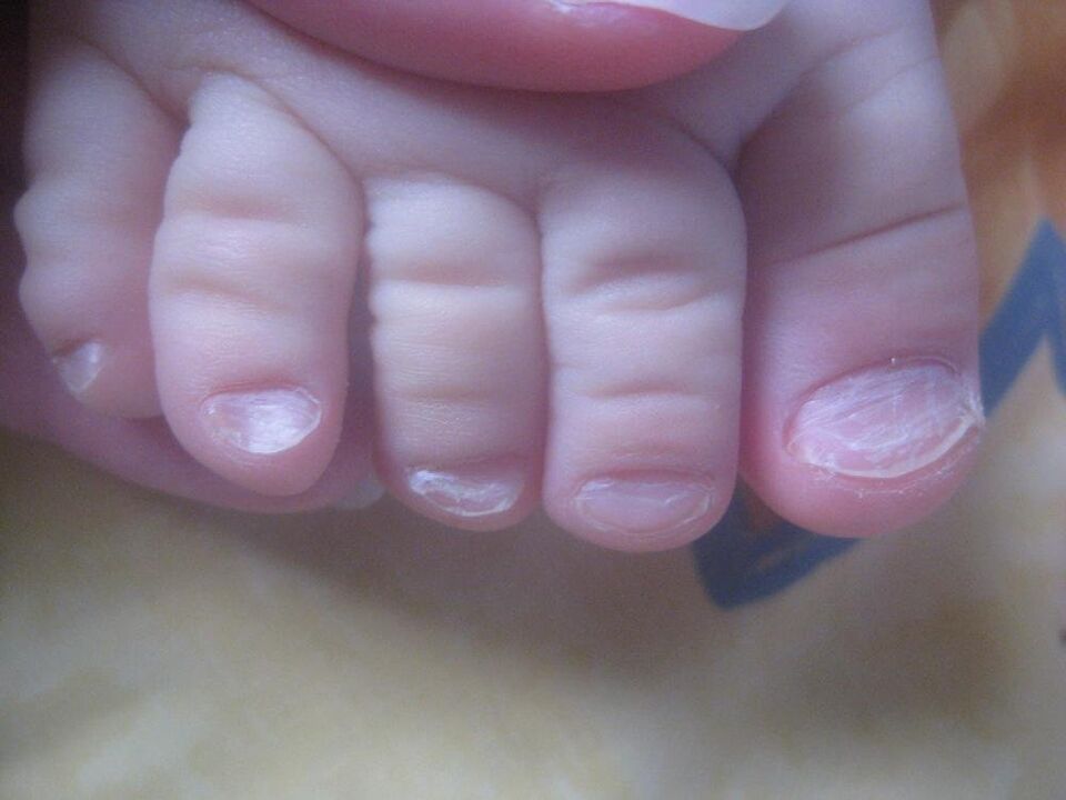 fungus on the nails in children