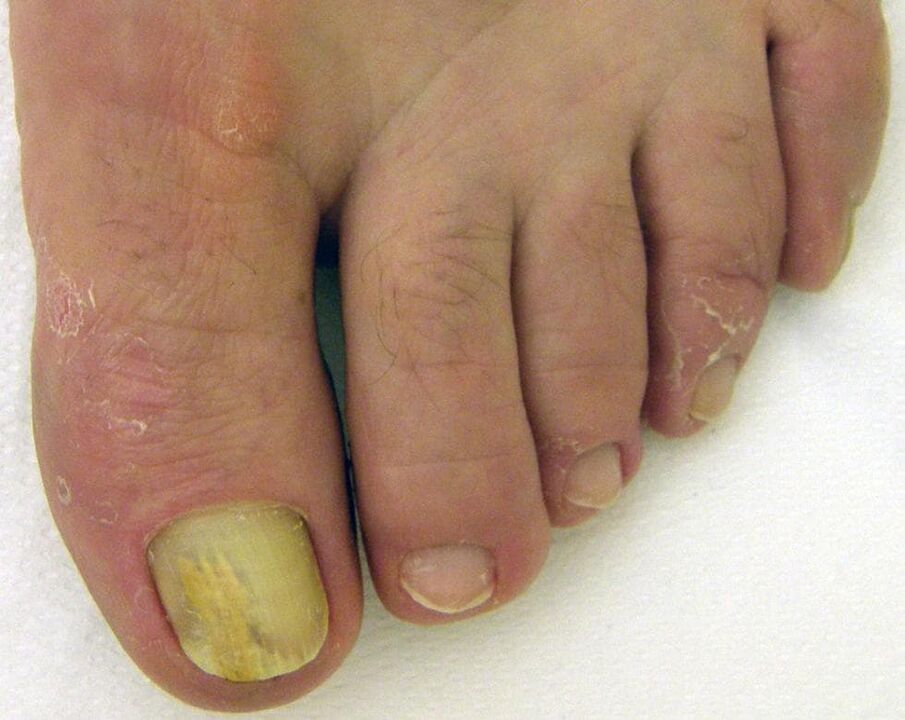 yellow toenail with fungus how to treat with drops