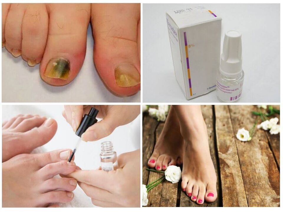 how to use varnishes against nail fungus