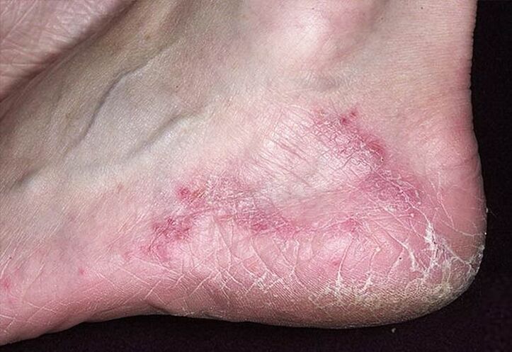 Cracked and red skin on heels is a sign of fungal infection