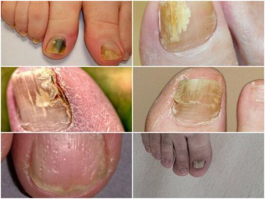 symptoms of a fungal nail infection