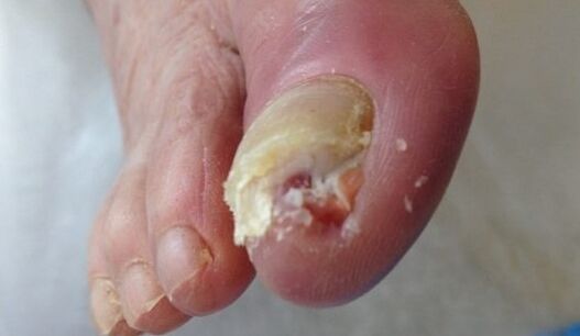 A sick nail