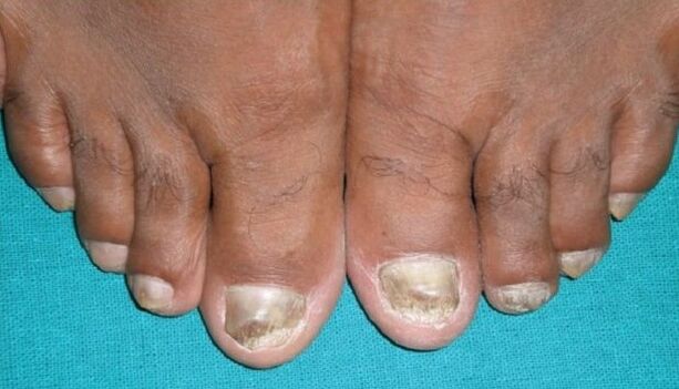 Fungus on the nails