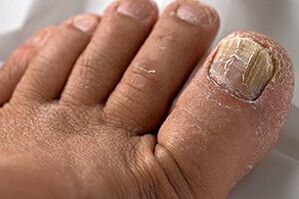 Nail fungus photo