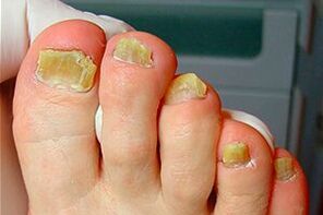Nail mushroom