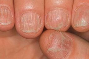 The mushroom lesion