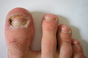 fungus on the nails