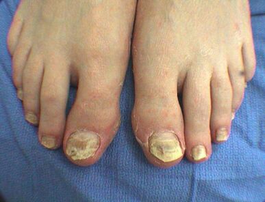Nail fungi symptoms