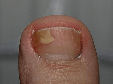mushroom to the left of the nail