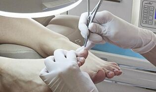 Nail surgical elimination in the presence of a fungus