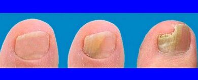 Steps of the development of the fungus on the toes