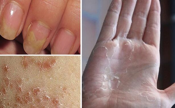 Can mycosis go to other parts of the body