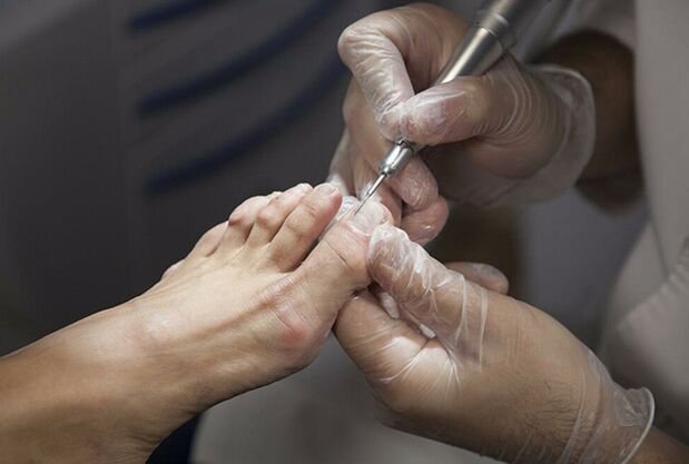 Diagnosis of the leg fungus