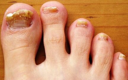nails affected by fungus