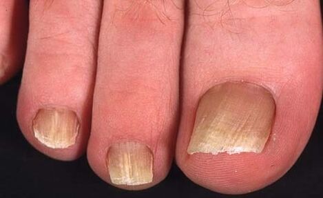type of nail fungus