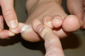 fungus on toes