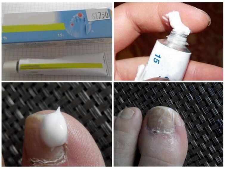 nail fungus ointments