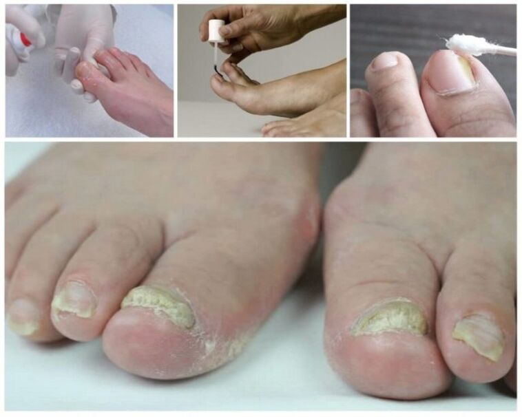 remedies for nail fungus