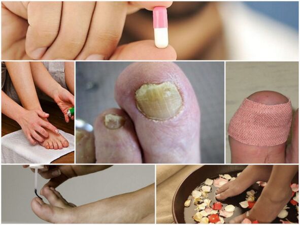 types of remedies for nail fungus