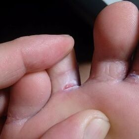 crack between the toes symptoms of fungus